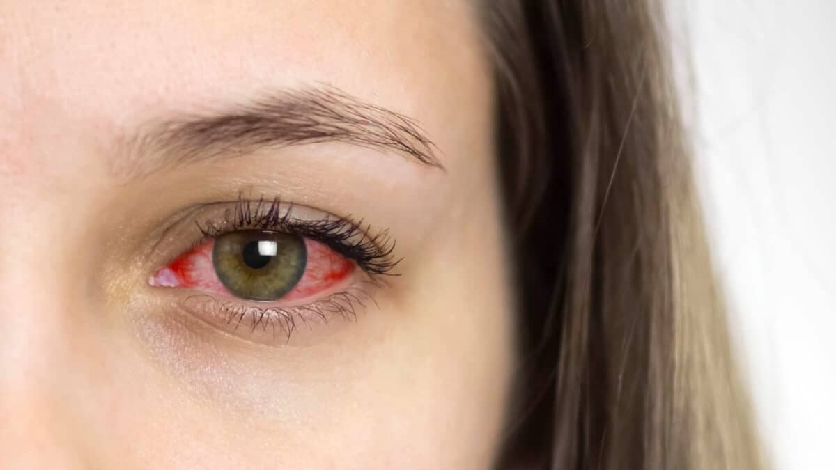 ¿Por qué el cannabis pone los ojos rojos?
