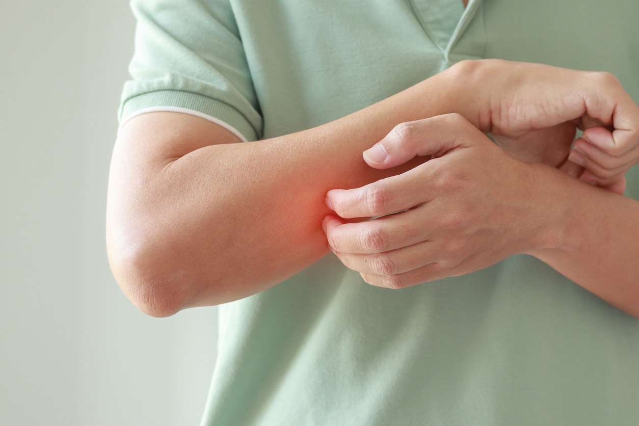 CBD para la Psoriasis: Posibles Beneficios y Aplicaciones